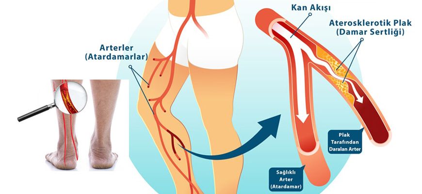 Periferik Arter Hastal Nedir?